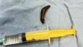 Boğazından &ccedil;ıkan canlı s&uuml;l&uuml;k doktorları bile şaşırttı