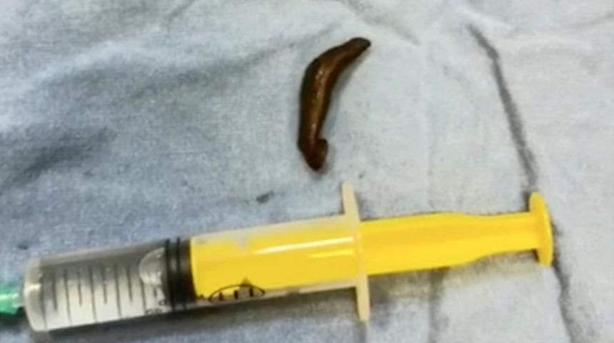 Boğazından &ccedil;ıkan canlı s&uuml;l&uuml;k doktorları bile şaşırttı: "İlk defa g&ouml;rd&uuml;m"