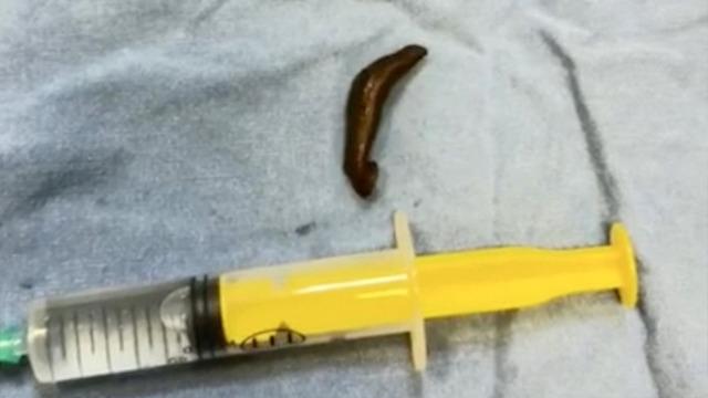Boğazından çıkan canlı sülük doktorları bile şaşırttı: İlk defa gördüm