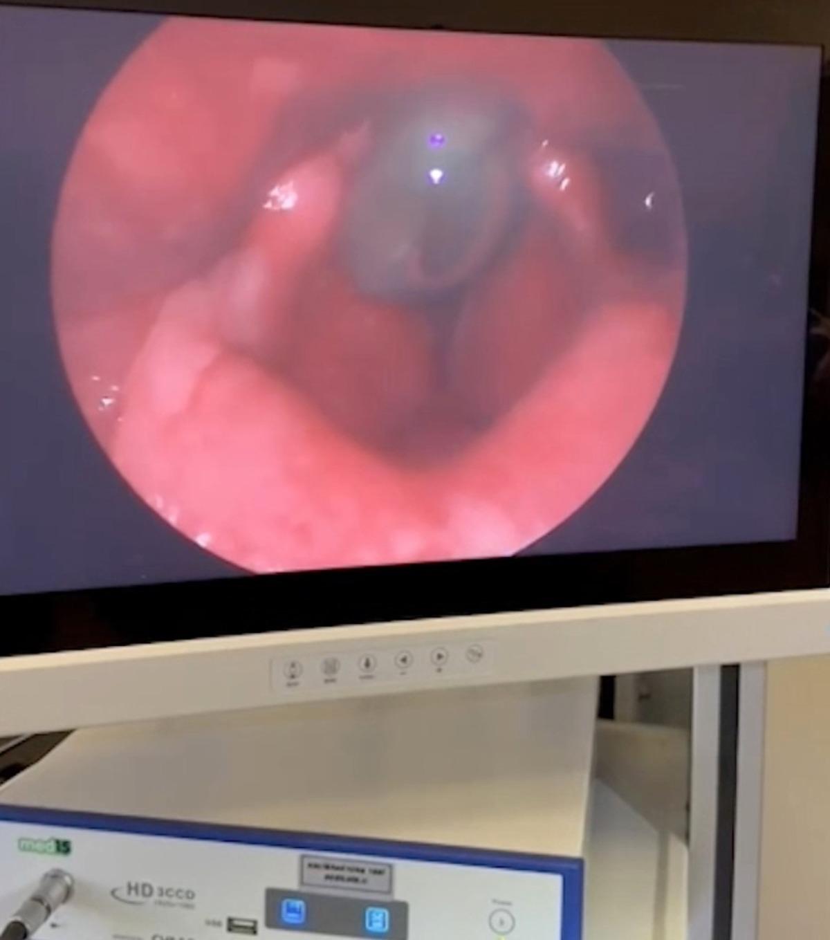 Boğazından &ccedil;ıkan canlı s&uuml;l&uuml;k doktorları bile şaşırttı: "İlk defa g&ouml;rd&uuml;m" 1