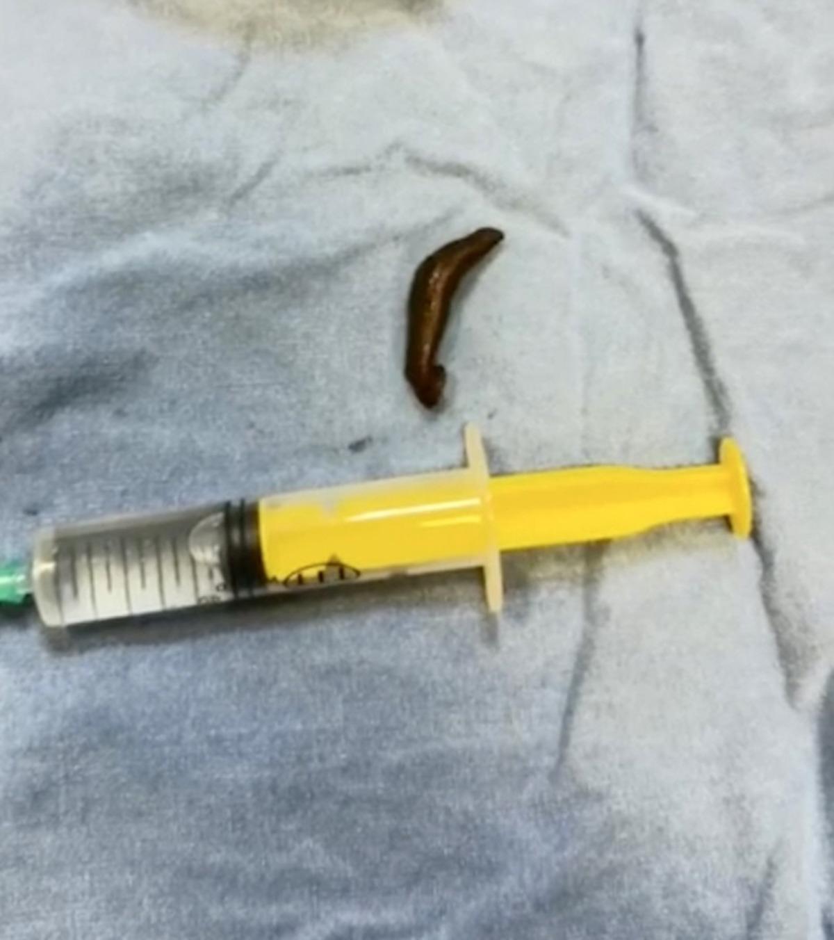 Boğazından &ccedil;ıkan canlı s&uuml;l&uuml;k doktorları bile şaşırttı: "İlk defa g&ouml;rd&uuml;m" 2