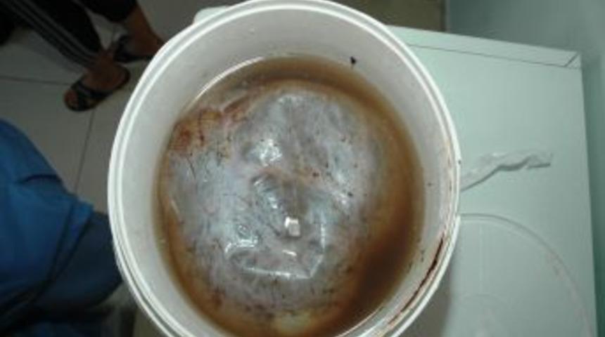 Karnından &ccedil;ıkan 7.5 kiloluk kist g&ouml;renleri şaşkına &ccedil;evirdi