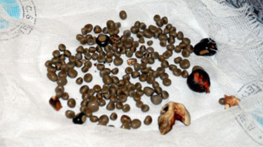 Ameliyatla bir b&ouml;brekten 198 taş alındı