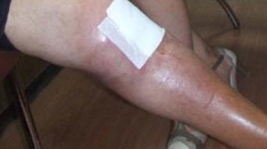 3 yıldır acılar i&ccedil;inde yaşıyor