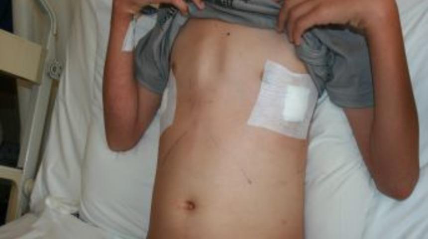 Akdeniz &Uuml;niversitesi Hastanesi&rsquo;nde 'kunduracı g&ouml;ğs&uuml;' tedavisinde yeni y&ouml;ntem