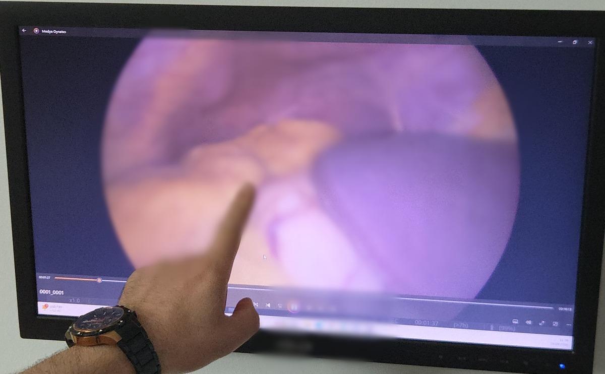 Kalbi sağda, t&uuml;m organları ters yerde: "İlk defa karşılaştık" 2