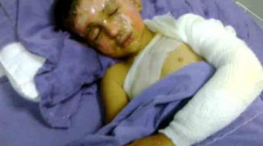 Ter&ouml;r &ouml;rg&uuml;t&uuml; yandaşlarının yaktığı 6 yaşındaki Sedat&rsquo;ın tedavisi s&uuml;r&uuml;yor