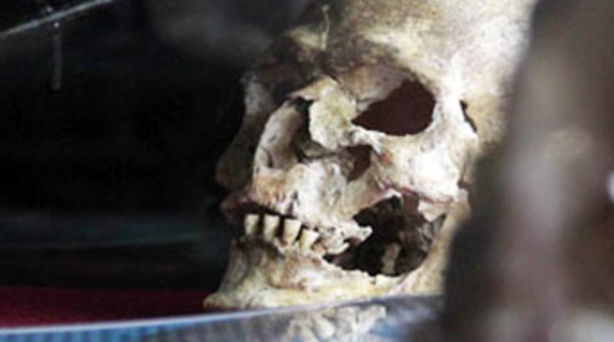 4500 yıl &ouml;nce beyin ameliyatı yapılmış!