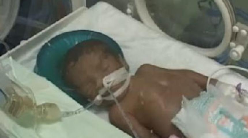 Mucize bebek yaşam savaşını yitirdi