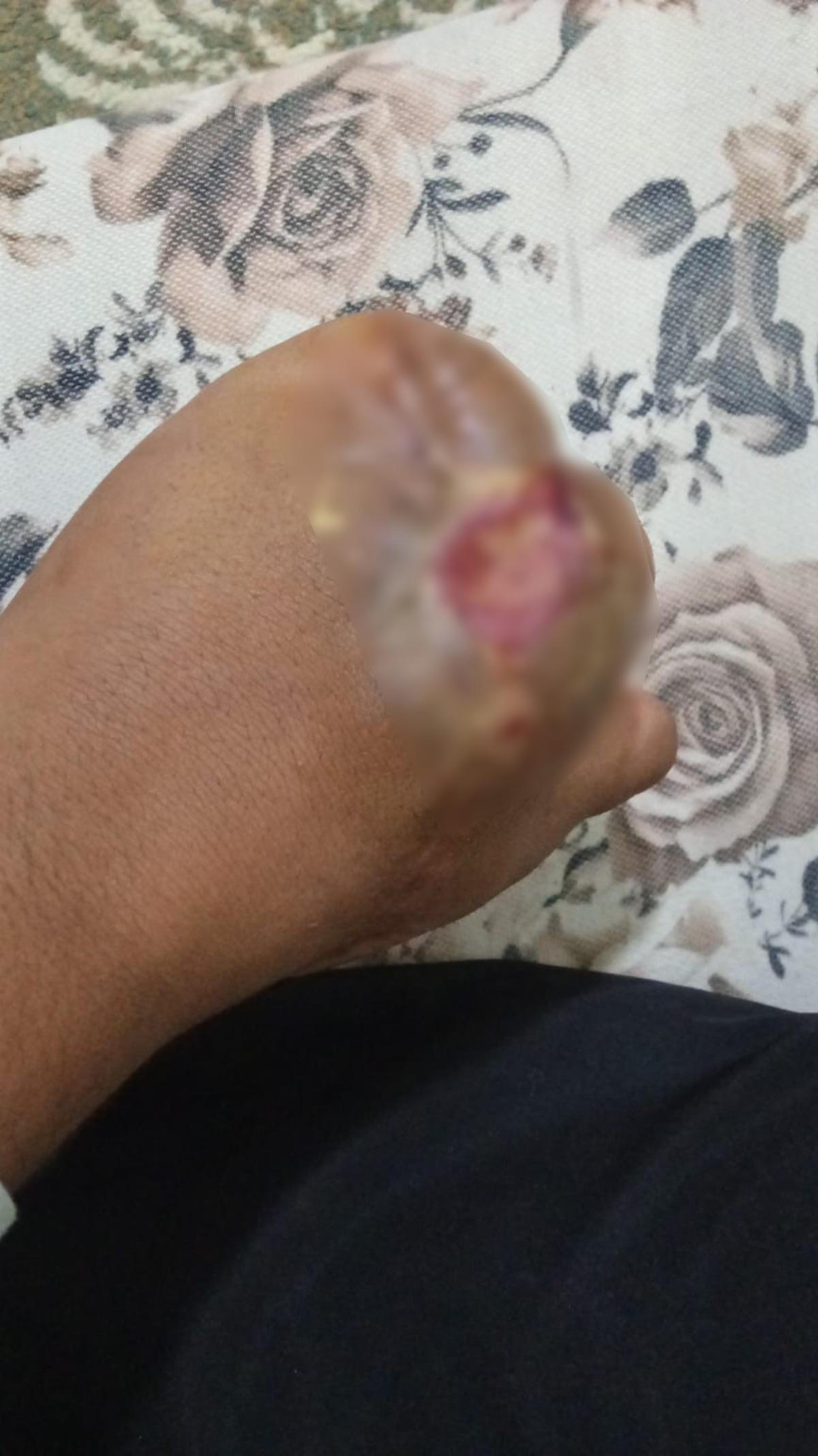 Elini makineye kaptırdı: Parmak başı 100 bin teklif ettiler! "Bağırdım, &ccedil;ağırdım dalga ge&ccedil;tiğimi sandılar..." 5