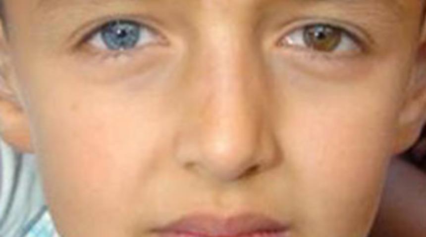 Bir gecede g&ouml;z rengi değişti!