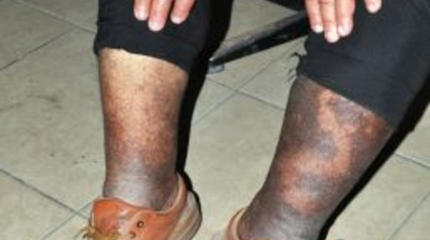 Yeşil kartı iptal edilen hasta yardım bekliyor