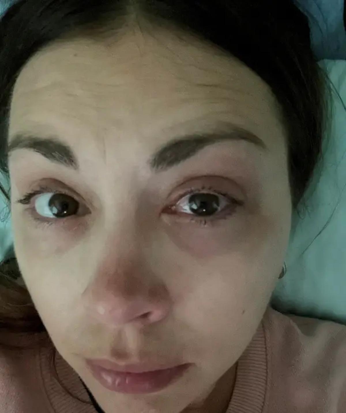 20 yıl boyunca makyajla uyudu hayatı kabusa döndü! Göz kapağı göz küresine yapıştı 1