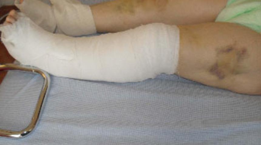 Balta sapıyla eşinin ayaklarını kırdı