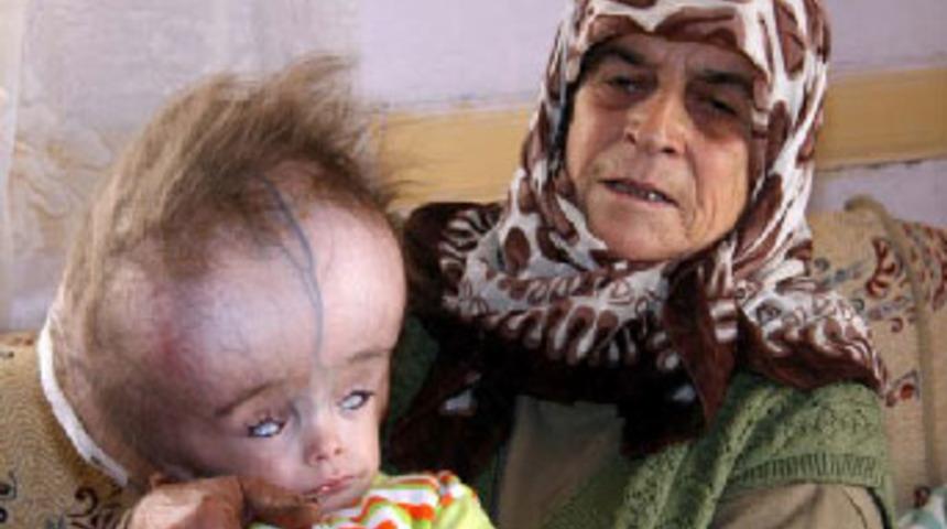 Hidrosefali hastası Eren kurtarılamadı