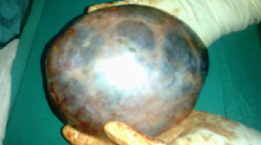 Hamile kadından 1.5 kiloluk kist &ccedil;ıktı