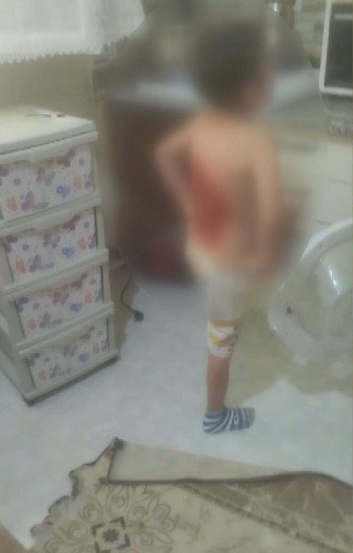 12 yaşındaki &ccedil;ocuğa kolonya d&ouml;k&uuml;p ateşe verdiler! 3