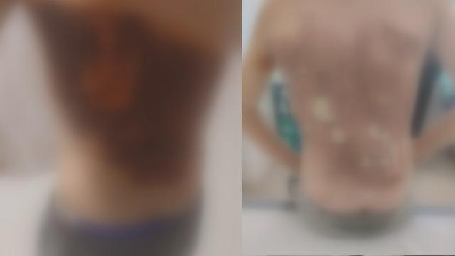 12 yaşındaki çocuğa kolonya döküp ateşe verdiler!