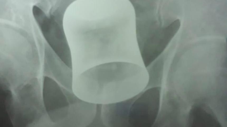 Böylesi görülmedi! 62 yaşındaki adamın anüsünden öyle bir şey çıktı ki...