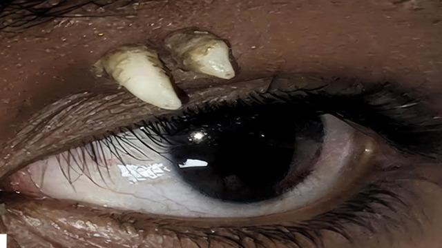 Tıp dünyasında ilk ve tek oldu: 16 yaşındaki çocuğun gözünde diş çıktı!