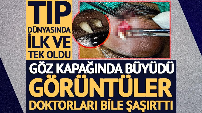 Tıp d&uuml;nyasında ilk ve tek oldu: &Ccedil;ocuğun g&ouml;z&uuml;nde diş &ccedil;ıktı!
