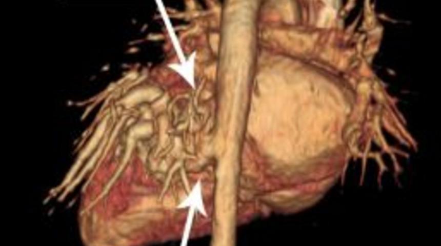 K&uuml;&ccedil;&uuml;k İrem, milyonda bir g&ouml;r&uuml;len hastalıktan 1 g&uuml;nde kurtuldu