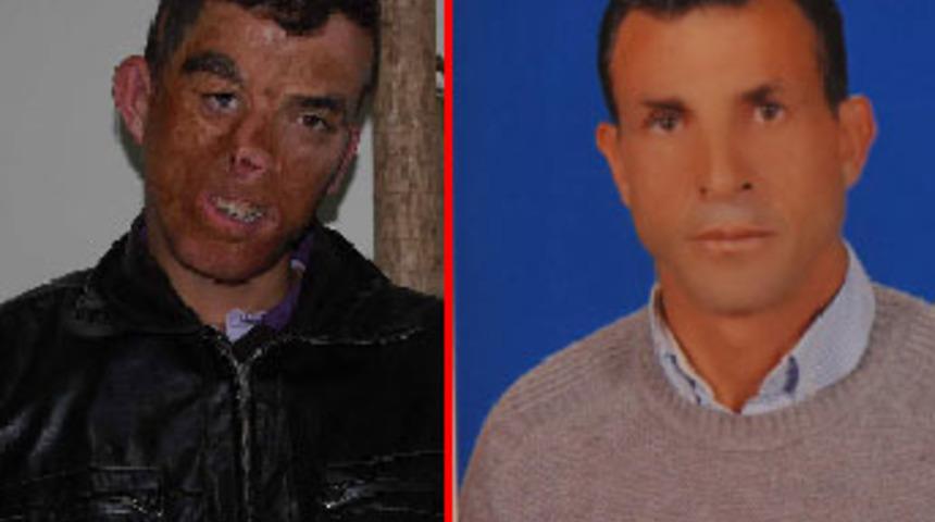 T&uuml;rkiye'de İlk y&uuml;z nakli ger&ccedil;ekleştirildi