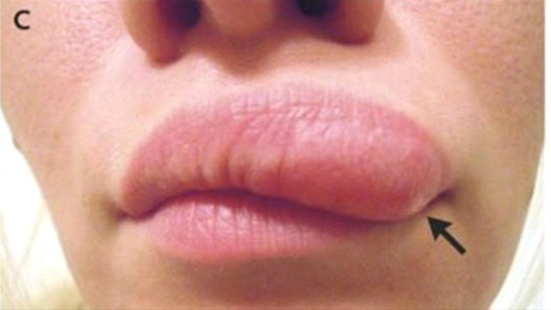 Yağ bezesi sandı, i&ccedil;inden &ccedil;ıkanı g&ouml;r&uuml;nce g&ouml;zlerine inanamadı