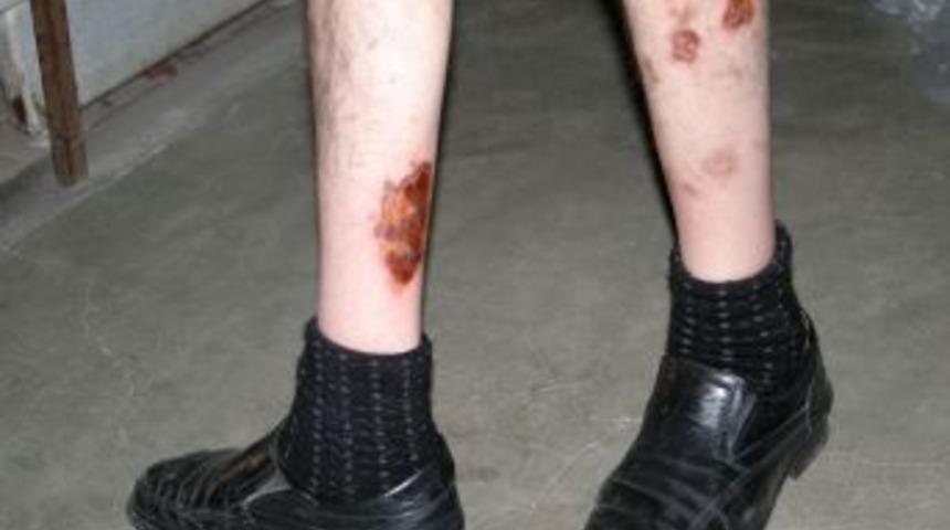 Şeker hastasına hem çalışamazsın diyorlar hem de yüzde 20 rapor veriyorlar