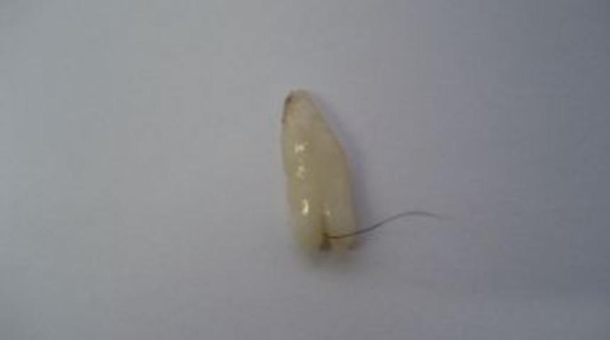 Yumurtalıktan &ccedil;ıkan diş ve sa&ccedil; teli doktorları şaşırttı