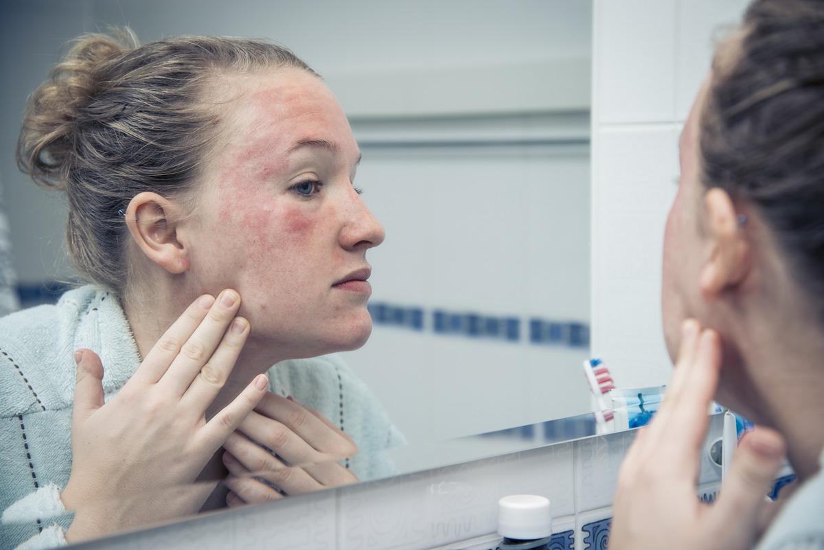 Kışın artıyorsa dikkat! Bu vitaminin eksikliği cilt sağlığını bozuyor olabilir 1