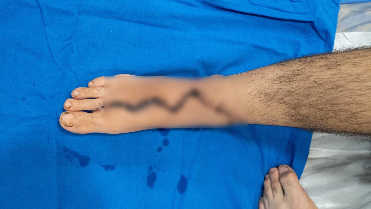 Okulu bırakıp &ccedil;ırak oldu: 13 yaşındaki Baran ın baş parmağı yerine ayak parmağı kondu! 2