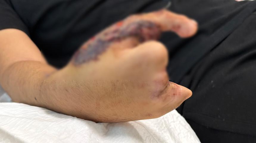 Okulu bırakıp &ccedil;ırak oldu: 13 yaşındaki Baran'ın baş parmağı yerine ayak parmağı kondu!