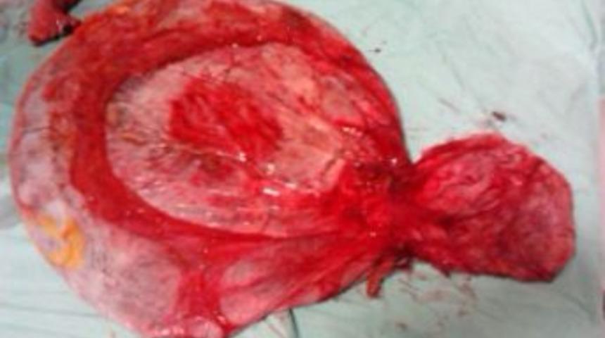 Karnındaki kitleden kurtulan kadın, 3 g&uuml;nde 20 kilo verdi