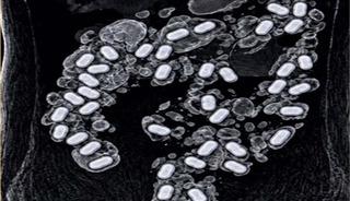 Havalimanında şüpheli yolcunun midesinden 322 gram metamfetamin çıktı