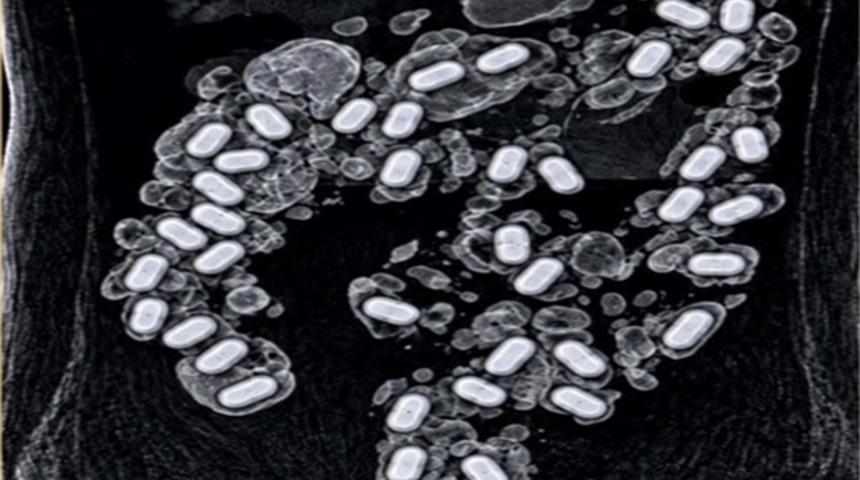 Havalimanında şüpheli yolcunun midesinden çıkanlar herkesi şaşırttı: 322 gram metamfetamin