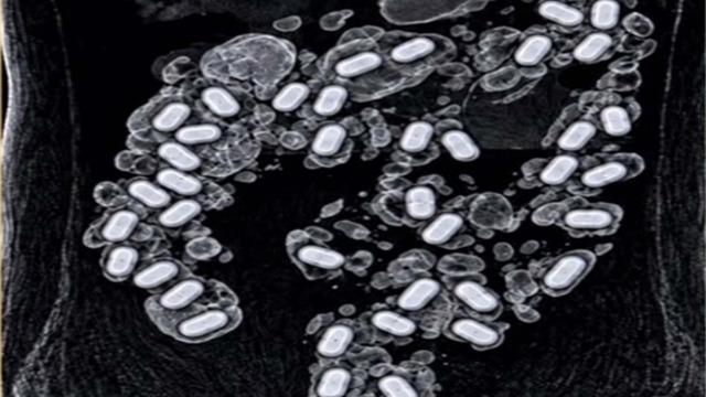 Havalimanında şüpheli yolcunun midesinden çıkanlar herkesi şaşırttı: 322 gram metamfetamin