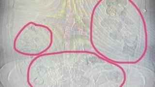 Midesinden uyuşturucu çıkan şahıs tutuklandı