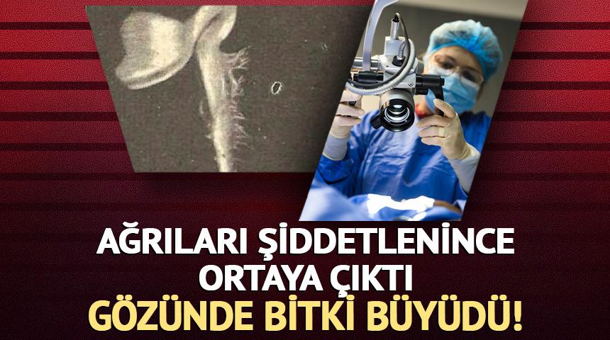 Ağrıları şiddetlenince ortaya &ccedil;ıktı: G&ouml;z&uuml;nde bitki b&uuml;y&uuml;d&uuml;!