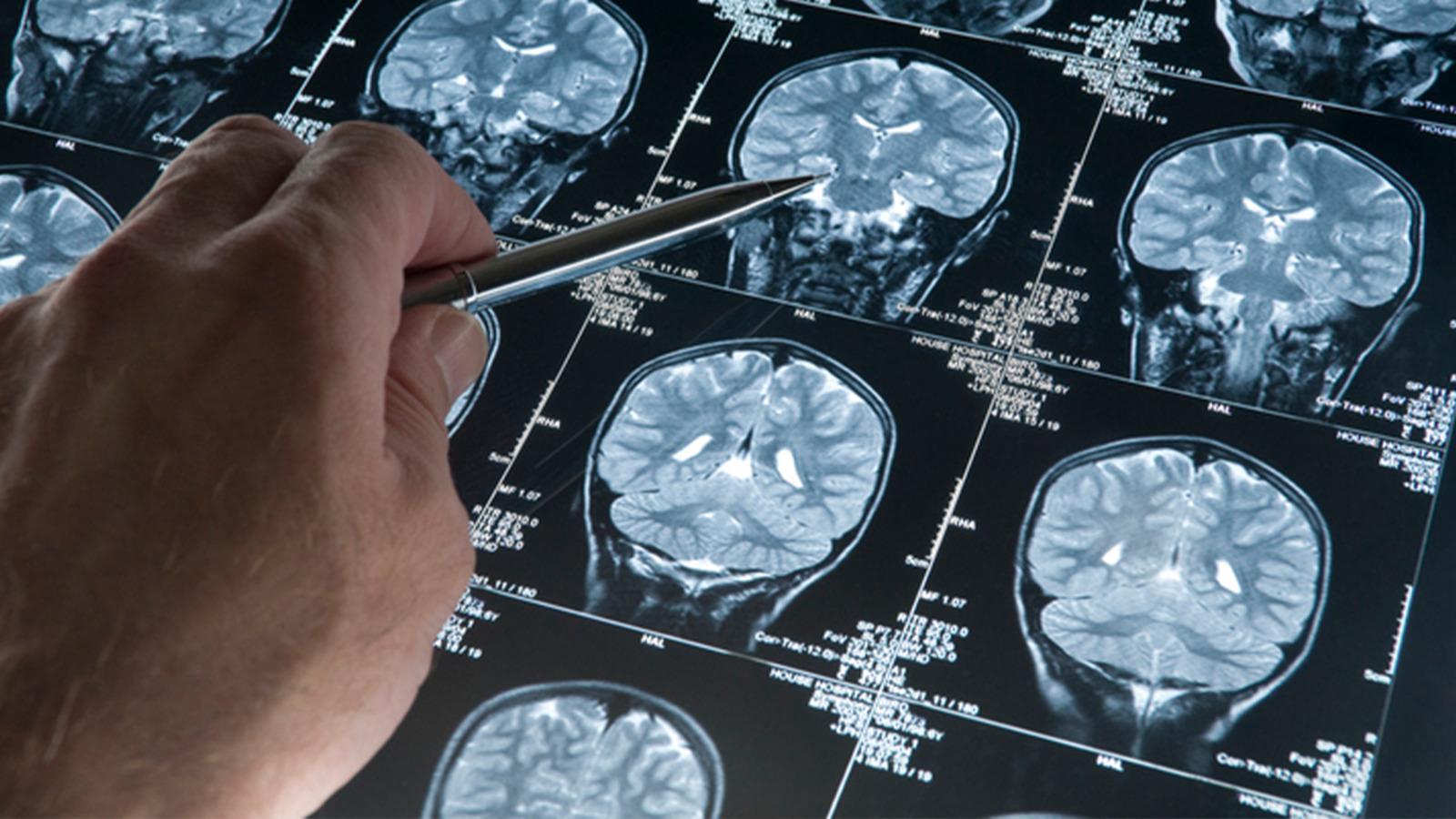 Alzheimer hastalığında yeni gelişme! Beyindeki damarları korumak mümkün olabilir