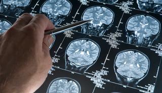 Beyindeki damarları korumak mümkün olabilir