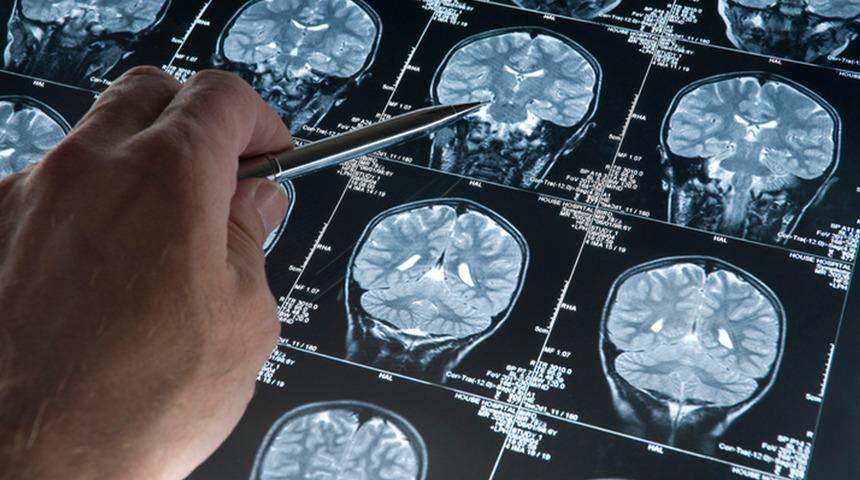 Alzheimer hastalığında yeni gelişme! Beyindeki damarları korumak mümkün olabilir