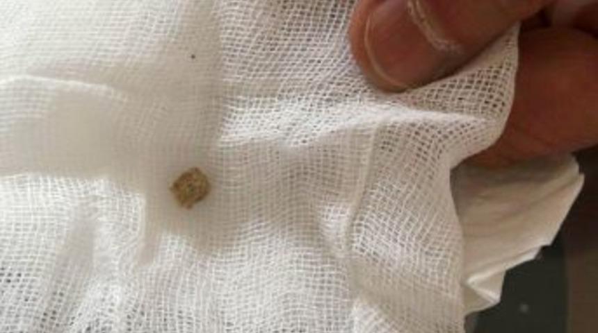 Hastaların b&ouml;brek taşlarını, Maden Tetkik Arama kırıyor