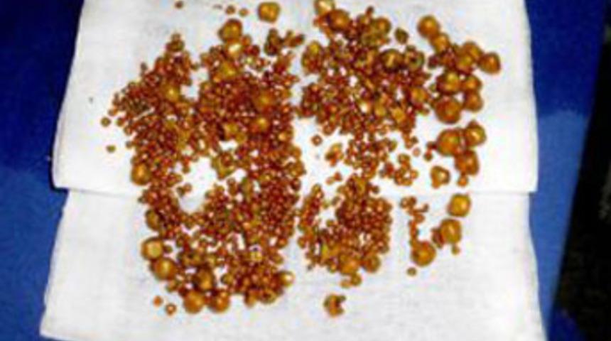 Safra kesesinden 901 adet taş &ccedil;ıktı!