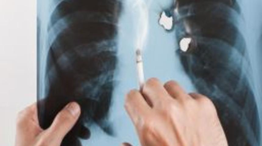 &quot;Akciğer kanserinin sebebi yüzde 90 sigara&quot;