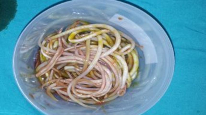 3 yaşındaki &ccedil;ocuğun bağırsağından 2 kilo parazit solucan &ccedil;ıkarıldı