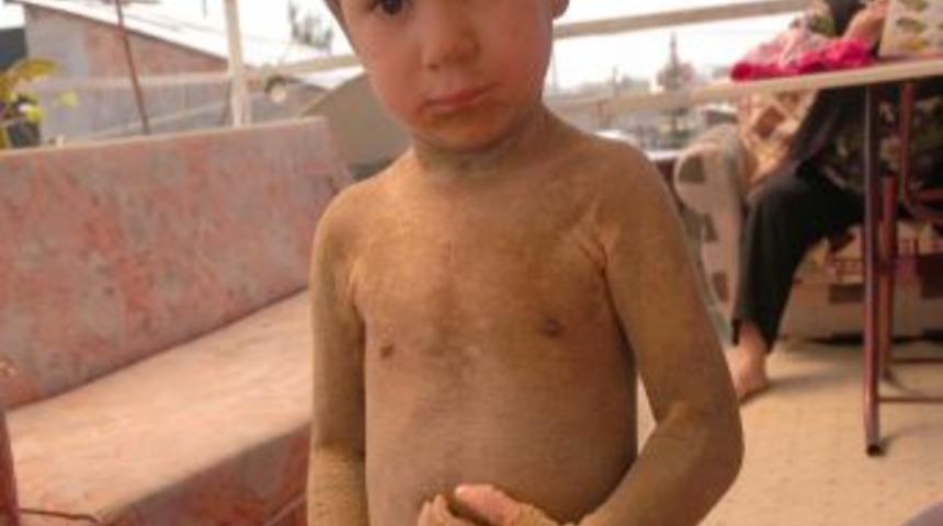 V&uuml;cudu timsaha benzeyen k&uuml;&ccedil;&uuml;k Dila yardım bekliyor