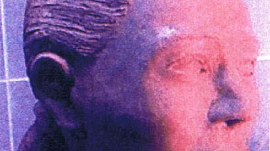 10 yıllık kafatasına y&uuml;zlendirme yapıldı