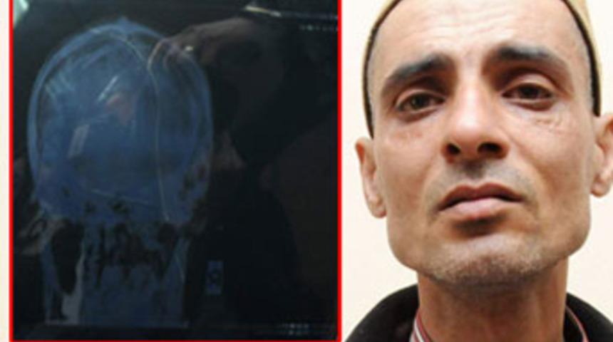 Kafasında iğnelerle yaşıyor