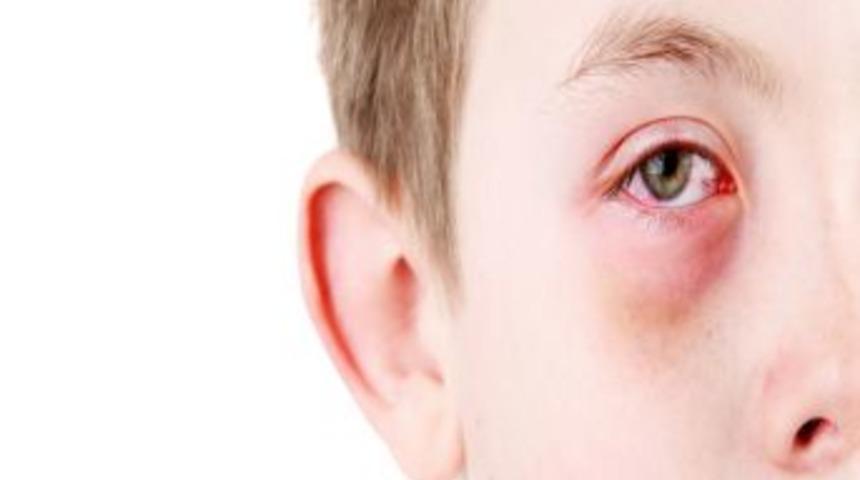 Uzmanlardan Alışveriş Merkezlerinde G&ouml;z Nezlesi Uyarısı